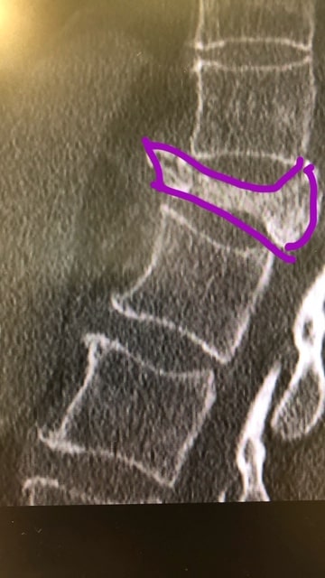 Sintomas de hernia discal graves. Cuando debes acudir a tu médico. 4 Lumbociática