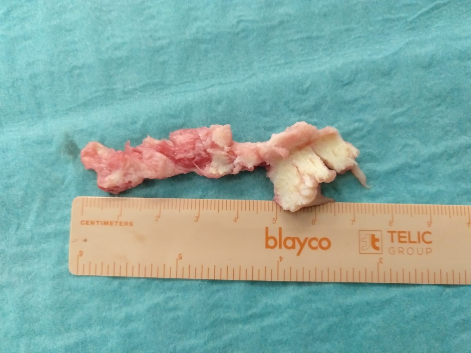 aspecto de una hernia discal