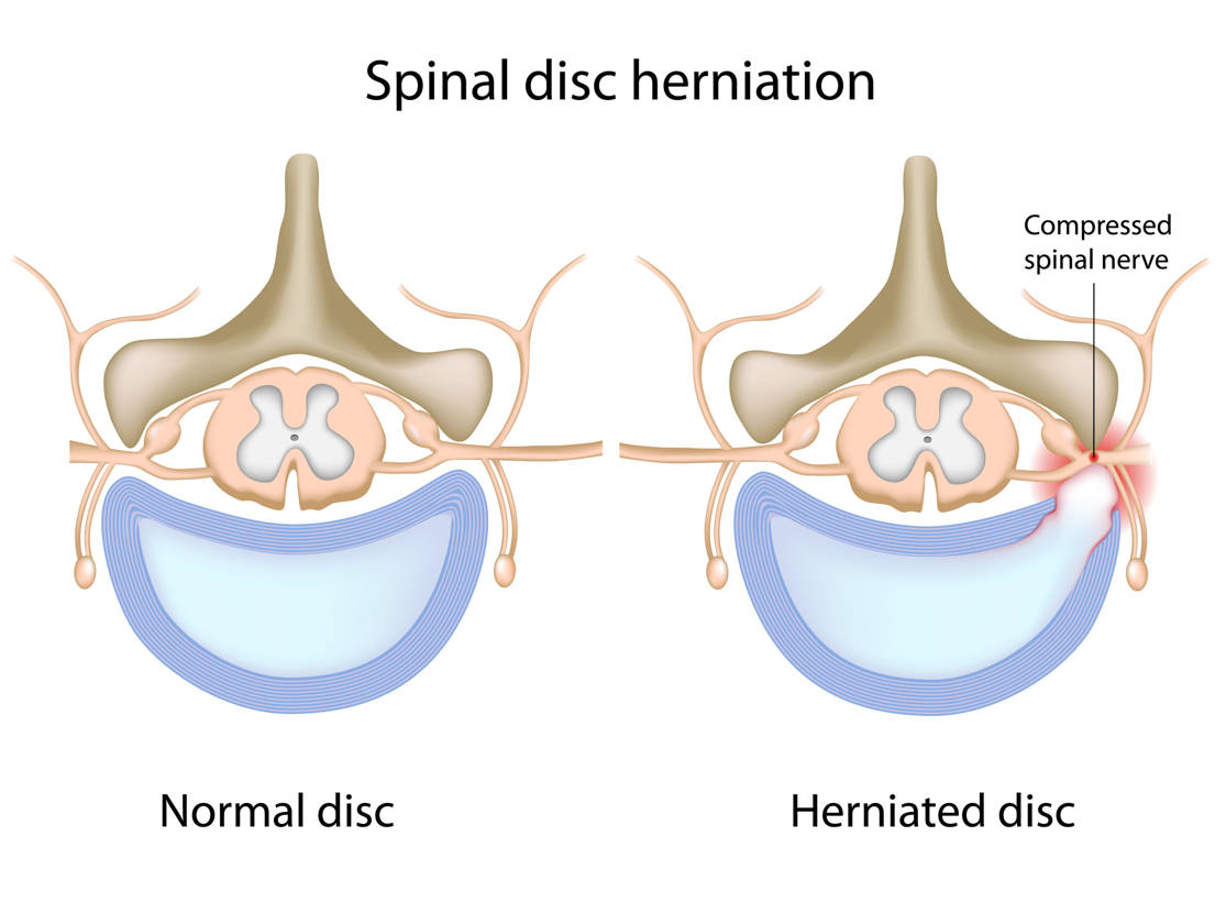 Ozonoterapia para hernia discal